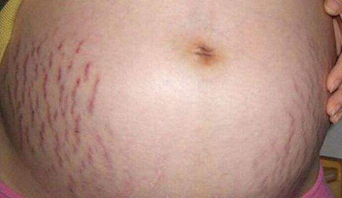怀孕肚子妊娠斑图片