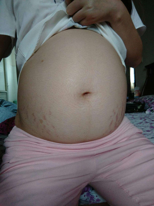 腹部妊娠斑