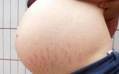 孕妇肚子上长小红点？这是妊娠纹的前兆吗？