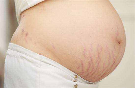 怀孕期间如何预防妊娠纹