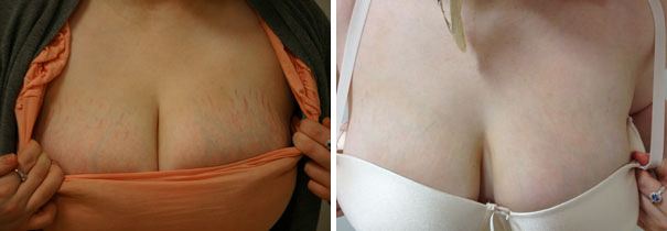 胸部妊娠纹与正常皮肤对比