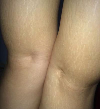 大腿妊娠纹图片