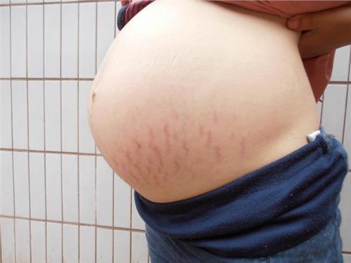 妊娠纹图片