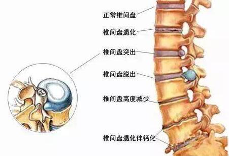 腰椎间盘突出：三个要点看懂就能恢复一半！有时候是不能按摩的！