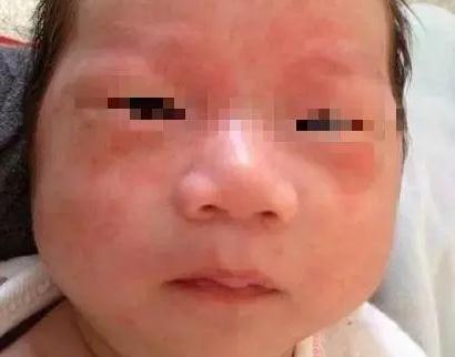 婴儿脂脂溢性皮炎的症状