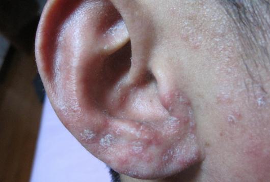 耳朵脂溢性皮炎的症状