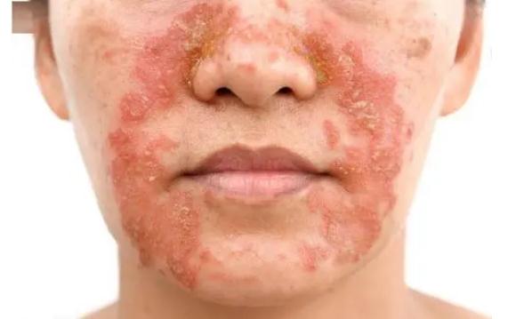 脸部脂溢性皮炎有哪些症状